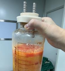 天水水动力吸脂手术要做多久？